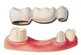 Bridge vs. Implants