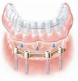 dentures3 (1)