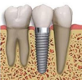 Single Unit Implant Crown