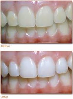 Tooth Whitening